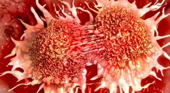 DESCOPERIRE MEDICALA: ALIMENTUL CARE UCIDE 85% DIN CELULELE CANCERULUI PULMONAR