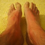 Ce este o erupție de stres și cum o poți trata?