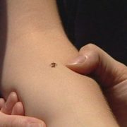 Alertă în Arad, din cauza căpușelor: Zeci de oameni au ajuns la spital în ultimele zile